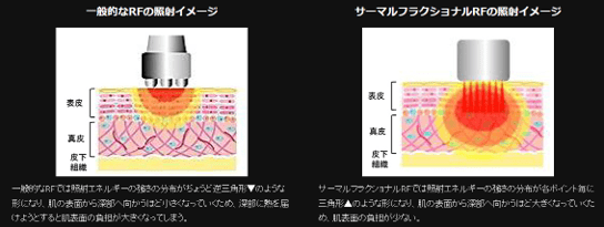 ビューティーサーマル